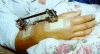 Elaine's Broken Wrist