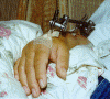 Elaine's Broken Wrist